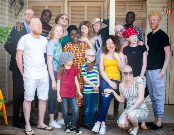 Dia Mundial de Consciencialização do Albinismo